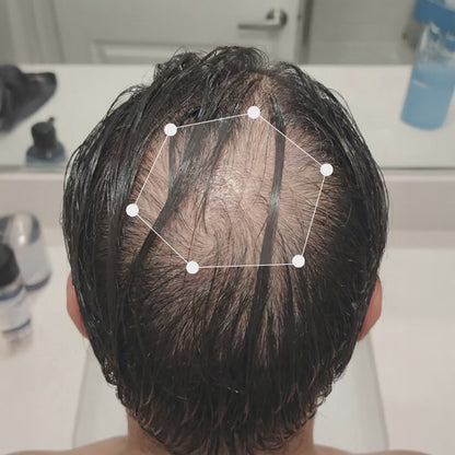KLARIOVA™ HAIR LOSS TREATMENT & REGROWTH